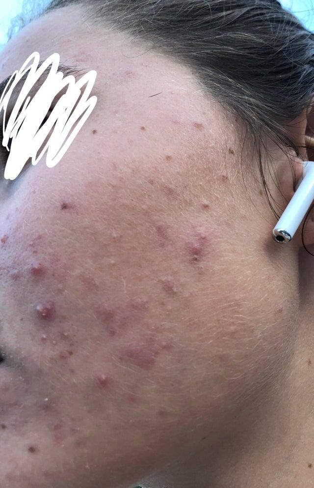 Panoxyl Acne Foaming Wash 10% Benzoyl Peroxide (new package)