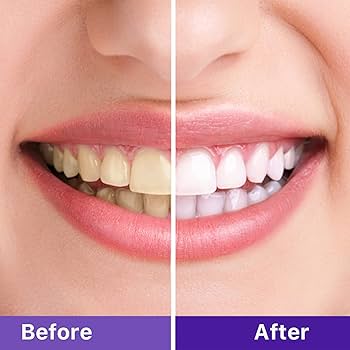 WHITE GLOW ENAMEL SAFE WHITENING