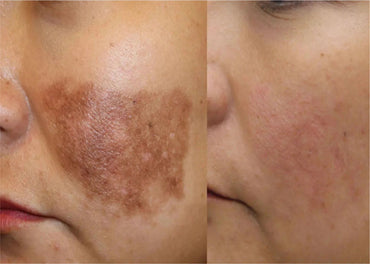 DR.MELAXIN CALCIUM CEMENRETE PICOTONIC SHOT PIGMENTATION SERUM